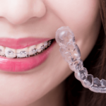 Orthodontie et appareils dentaires : ce qu’il faut savoir