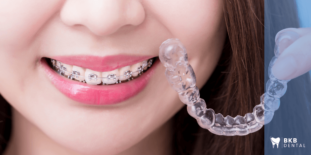 Orthodontie et appareils dentaires : ce qu’il faut savoir